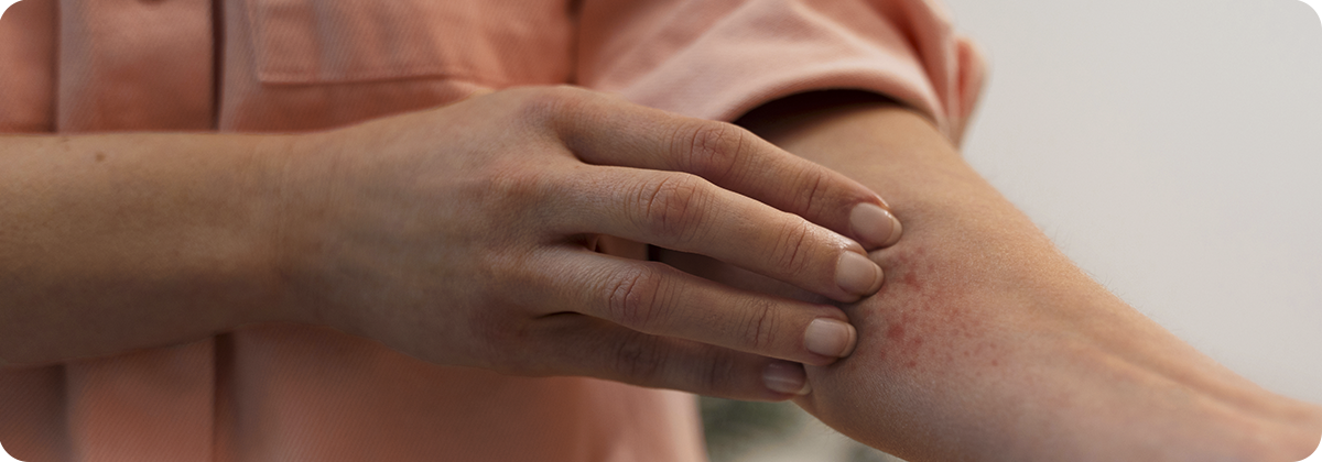 Нервный дерматит