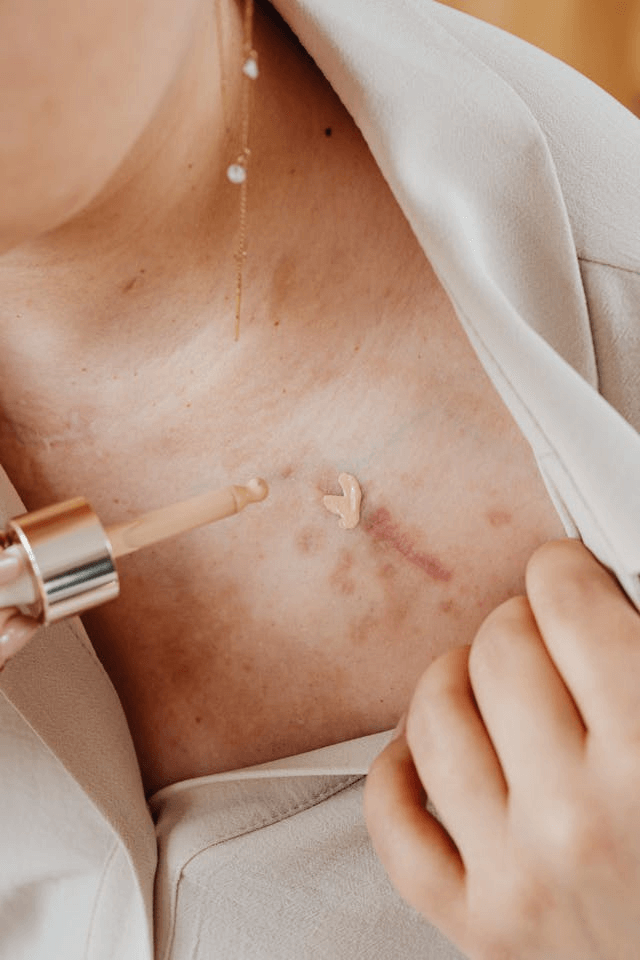 Наносят средство на шрам