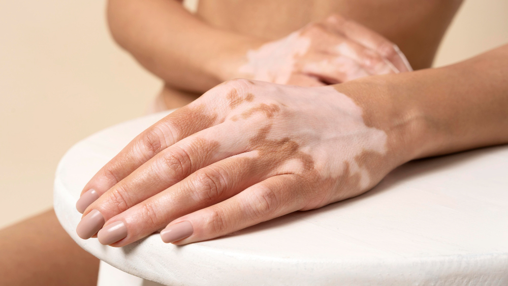 Руки с витилиго