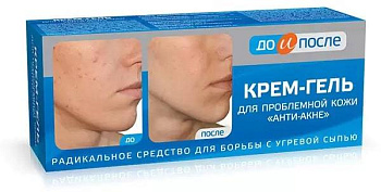 ДО и ПОСЛЕ, крем-гель Анти-Акне для проблемной кожи, 50 мл